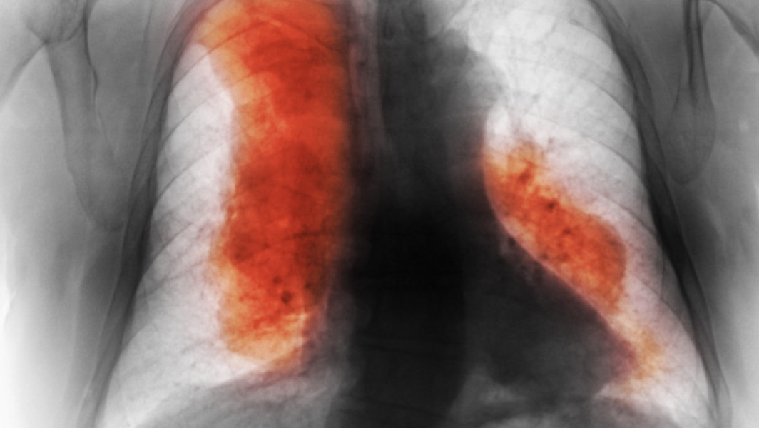Decesele cauzate de cancer la nivel mondial ar putea ajunge la 18,5 milioane în 2050