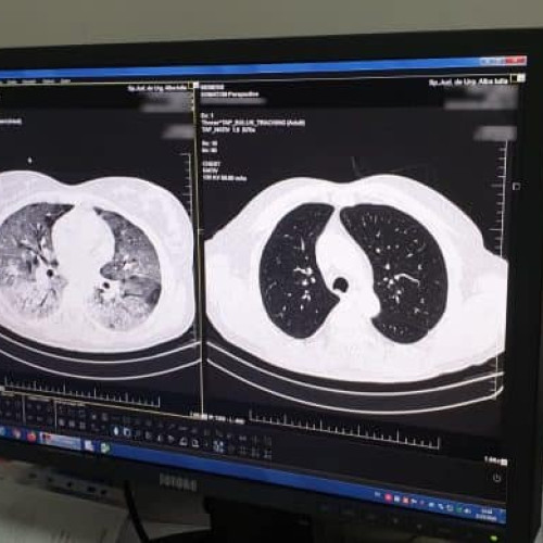 24 martie: Ziua Mondială de Luptă Împotriva Tuberculozei. Expert: Există o stigmă pentru pacienții cu această boală